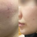 창원 상남동 톡스앤필 더블리쥬란 후기 !!!!🤍🤍