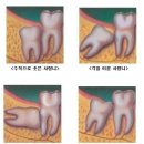 수성사랑니치과의원 네이버블로그
