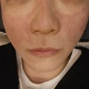 부산 피부과 전문의 화명동 피부과 생애 첫 쥬베룩스킨 3cc 후기