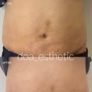 다솜바이오 | 원무 도아 에스테틱ㅣ지방흡입 후기 바이오본드 고주파케어로 해결🔥지방흡입수술 후 추천관리