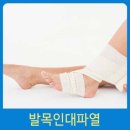 센스짐24 춘의점 | 춘의역pt/춘의동헬스장 발목 인대 파열, '삐었다'로 넘기면 안 되는 이유