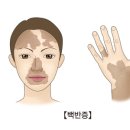 백반증[Vitiligo]피부질환 이미지