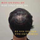 탈모문신 각 유형별 가격과 후기