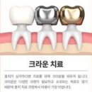 문산 서울미치과 앞니크라운 치료 후기/ 내돈내산