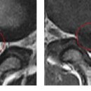 forever님의 허리디스크 mri 사진 판독 입니다. 이미지