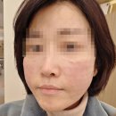 나이스피부과의원 | [피부관리] 속 건조 탈출과 광채 피부 완성!/리쥬란 HB plus 후기/나이스 컬러