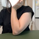 팔고개 | 애기낳고 7개월만에 수원 팔지방추출주사한 당일 리얼 후기(통증, 멍, 붓기, 일상생활)