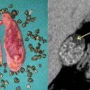체액메마름증인 담석증, 오메가3는 심혈관 건강과 무관 이미지