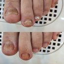 문제성발톱, 발톱무좀관리 다락방