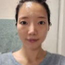 코~오 자자 | [눈밑지방재배치 비수면 후기] 압구정 눈밑지 국소마취 수술 1일차 ~ 7일차 후기 : 진물, 눈곱, 붓기...