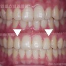 인비스치과의원 | 창원투명교정, 비뚤한 치아 투명교정 치료 케이스
