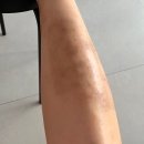 약촌한의원 | 피부 습진/한포진/건선? 한약 치료 @서울약촌한의원