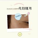 방화강서8기동단 | [방화] 강서구색소제거 강서구흑자제거 ROOM 110 흑자제거 솔직후기