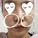 더리브 사거리B | 미아사거리역 리브이 후기 _ 안 아프게 예뻐지는 리프팅