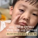 노들담한의원 | 아이 사마귀 원인, 번짐, 완치까지의 과정