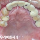 자연치 살려내는 당산 치과 신경 치료 및 어금니 임플란트 수술 후기