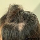 피부공감 레푸스 부천옥길점 | 부천스타필드 두피관리 옥길탈모성지로 유명한 닥터모락 옥길점 솔직후기, 주차