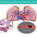 항당뇨병약인 SGLT-2i가 폐동맥고혈압에도 효과가 있다는... 이미지