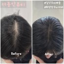 화정현대파라다이스1차아파트 | 고양 일산 화정 더동안뷰티 정수리탈모 두피채움 정수리커버 후기