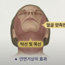 이지성형외과의원 | 안면거상 수술 효과, 가장 흔한 3가지 오해 (팔자주름 얼마나 펴질까요?)