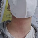 리쥬브포맨의원 | 서면 남자 턱수염 레이저 제모 리쥬브포맨의원 5회 후기