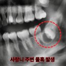 THE바른태권도장 | 달서구 사랑니 발치 , 발치를 해야하는 시기와 이유