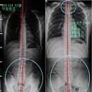 청소년기 측만증을 치료하지 않았을때 진행되는 사례 이미지