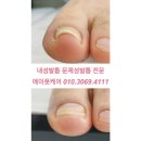 말려있는 U자 파고드는 내성발톱 내향성발톱 교정하는방법 #에이풋케어 #인천 #부천 #부평 이미지