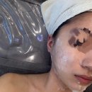 루디아뷰티 | [루디아] 평택 뷰티샵 엑소좀mts 2회차 후기+효과 (내돈내산)