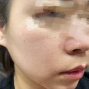 킴스의원 | 하단 피부과 킴스뷰티의원, IPL 레이저 2회차 효과 후기