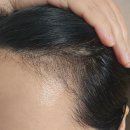 현암로89번길 | 분당 용인 두피문신 후기 - 닷포유 SMP에서 헤어라인한 솔직후기