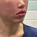 이노라인 | 강남구청역 눈밑지방재배치+이노플러스 후기 | 팔자주름·양볼·입술필러