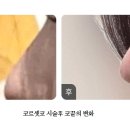 복코성형 부작용 재수술 걱정없는 에르네의원 코르셋코 해결 후기