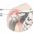 오십견과 혼동 쉬운 회전근개 파열의 구별 이미지