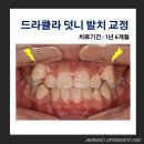 드라큘라치과의원 | 드라큘라 덧니(송곳니) 발치 교정 전후 (치료 기간 : 1년 6개월)