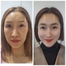 부산대인셀덤 | [인셀덤사용후기]피부과 성형외과 시술없이 가능한 인셀덤홈케어 사용법.7일프로그램