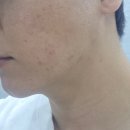 올스킨 | 대전 여드름 관리 유성 올스킨 압출 후 재생관리 후기