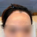 주식회사투썸플레이스천안불당점 | 천안 불당동 왁싱데이 후기 헤어라인 왁싱 M자 헤어라인 개선(브라질리언 슈가링)