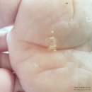 보명약국 | 발바닥사마귀 제대로 제거 해볼거에요.