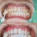 미백 | 인천 계양구 치과 추천 치아미백 후기