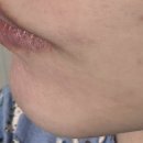 민메디컬 | [미백 항산화] 영국산비타민앰플 졸로픽스 민타비 20 논크림 사용후기 구매팁