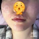 하나약국 | 포텐자&amp;리쥬란&amp;쥬베룩 펌핑팁 통증(수면마취x) _ 내돈내산 피부과 시술 후기(의정부 피부과)