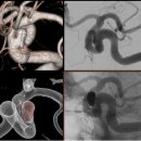 2011-11-22 비파열성 뇌동맥류 코일색전술 이미지
