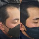 더자 | 양산두피문신 내돈내산 후기, M자탈모 이제는 더이상 감추지 않아도 됩니다