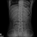 폐쇄성 장마비(mild paralytic ileus) 이미지