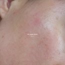 하린코스메틱 | 접촉성 피부염 에스트라 진정세럼으로 복구함! 피부 전, 후 사진