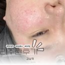 강남피부과 리주란&amp;더블타이트닝 후기