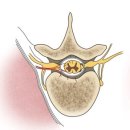 척수병증[Myelopathy]뇌신경정신질환 이미지