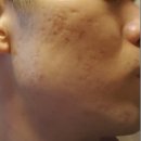 시중한의원 | 여드름흉터한의원 패인 유형 개선 후기