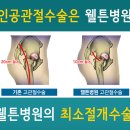 1주일 만에 퇴원하는 인공 고관절수술 방법 이미지